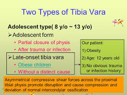 Case Presentation Tibia Vara Ppt Video Online Download