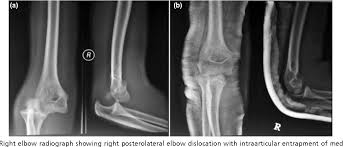 Flex your wrist toward your forearm. Figure 1 From Intra Articular Entrapment Of Medial Epicondyle Fracture Fragment In Elbow Joint Dislocation Causing Ulnar Neuropraxia A Case Report Semantic Scholar