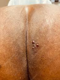 Image result for genital herpes