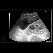 Hay tres tipos de ultrasonido pélvico: Ultrasonido Abdomen Superior Ciem