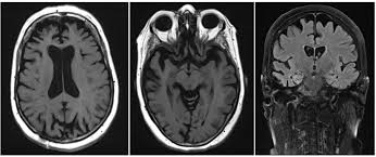 Common symptoms of lbd include changes in thinking ability, significant movement problems, sleep disorders, dizziness, fainting, urinary incontinence, and constipation. Frontiers The Use Of Biomarkers And Genetic Screening To Diagnose Frontotemporal Dementia Evidence And Clinical Implications Neuroscience