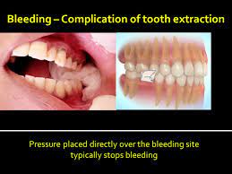 Bleeding will only stop if pressure is applied for long enough. Oral And Maxillofacial Surgery Consulting Specialist Ppt Download