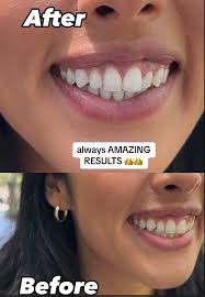 White Glo Toothpaste Honest Review | TikTok