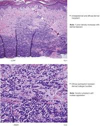 Image result for Merkel Cell Carcinoma