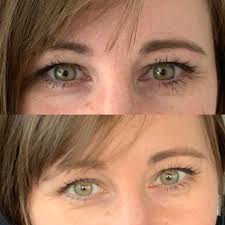 I'm free and light and happy and natural! My kids are happy, I'm happy. I  can BREATHE! Located in Indianapolis and went to an amazing micro surgeon,  Dr. Kristine Kelley. She was