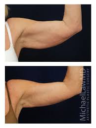 Arm Lift Patient 1 Raleigh Nc Plastic Surgeon Dr Michael Law Liposuction Plastic Surgeon Cosmetic Surgeon