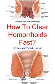 Hemorrhoids Are A Problematic Trouble That Can Be Prevented Below Are Some Tips Of What They Are Home Hemorrhoids Treatment Bleeding Hemorrhoids Hemorrhoids