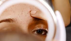 Vos problèmes, nos solutions ! Peau Mixte Grasse A Acneique Conseils Pour Reguler Le Sebum