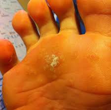 Dornenwarzen schnell loswerden (Warzen, Dornwarze)