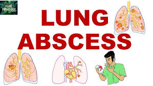 Image result for Lung Abscess