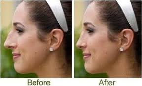 Non Surgical Rhinoplasty In Pakistan Lahore Check Price Rhinoplasty Surgery Nose Job Best Plastic Surgeons