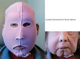 What's different about head and neck lymphedema. B, Smith. by Canadian  Lymphedema Framework