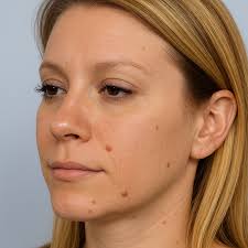 Skin Tag & Lesion Removal Buckshaw Chorley