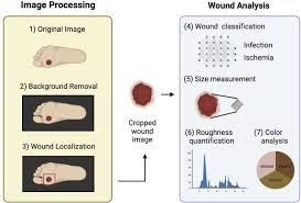 Image result for IDSA Diabetic Foot Wound Classification