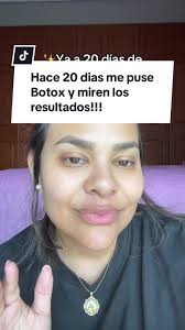 Resultados Sorprendentes de Botox con DRA. DIANA MAR