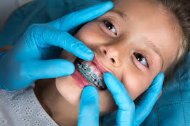 Braces are becoming more and more common as we try to hide our flaws. How Do I Know I Need Braces