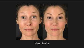 On average, prices can range from $10 to $20 per unit. How Many Units Of Botox Do I Need Nazarian Plastic Surgery La