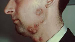 Ringworm Symptoms Pictures Treatment Diagnosis More If you look at dog ringworm pictures then you would notice that it can happen anywhere. ringworm symptoms pictures treatment