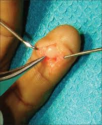 glomus tumor of the fingertips a
