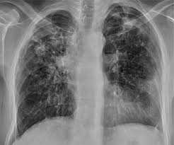 Abnormalities on chest radiographs may be suggestive of, but are never diagnostic of tb, but can be used to rule out pulmonary tb. Importance Of Tb Contact Investigations Sciencedirect