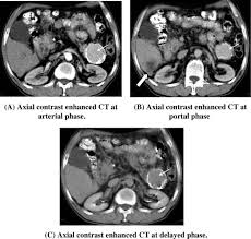 Computed tomography (ct or cat) scan. Role Of Multi Detector Computed Tomography In The Evaluation Of Pancreatic Tumors Sciencedirect