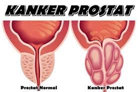 Image result for kanker