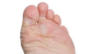 Enlever un cor au pied par ponçage. Cors Au Pied Et Durillons Quelles Solutions Passionsante Be
