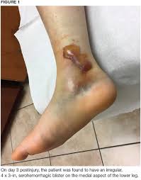 Mobilization that can have amazing results for acute and especially chronic ankle sprains. Woman 57 With Painful Swollen Ankle Clinician Reviews