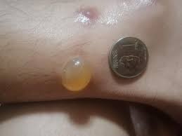 Subscribe to ketv on youtube now for more. My Doctors Said It Might Be A Spider Bite I Did Find A Tiny Spider On My Bed Multiple Bites Around My Ankles But No Other Part Of The Body First Signs