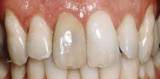Bleaching Devitaler Zahne Zusatzleistung Endodontie Zwp Online Das Nachrichtenportal Fur Die Dentalbranche
