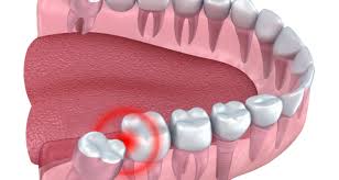 You might also feel soreness and an urge to itch in the region. Everything You Need To Know About Wisdom Teeth Supremia Dentistry