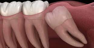You may be referred to an oral surgeon if your case is very complex. Can T Afford To Remove Wisdom Teeth