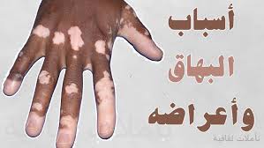 مرض البهاق اسبابة واعراضة وعلاجة قلوب فتيات