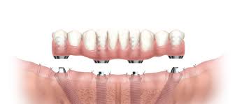 Image result for dental implant