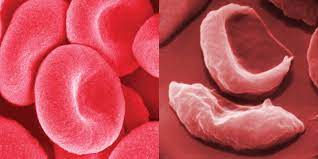 The most common type is known as sickle cell anaemia (sca). Sickle Cell Anemia Symptoms Sickle Cell Trait Treatment Britannica