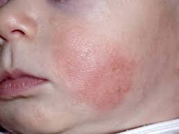 Sarpullidos Comunes En Los Bebes Como Compartirlos