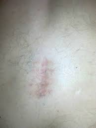 Image result for vyhřezlá ploténka