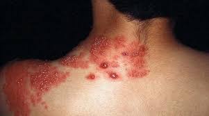 Antes de que aparezca el sarpullido, por lo general las personas. Que Es La Culebrilla Policlinica Metropolitana