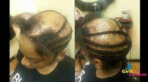Alopecia Sew In Done By 3 Girls And A Needle Alopecia Hairstyles Alopecia Frontal Hair Loss
