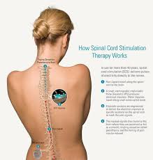 How Spinal Cord Stimulation Therapy Works Low Back Pain Spinal Cord Stimulator Chronic Pain Nerve Pain