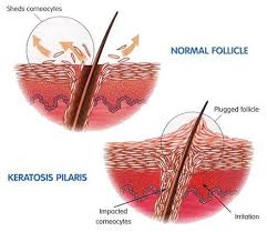 Image result for Keratosis pilaris
