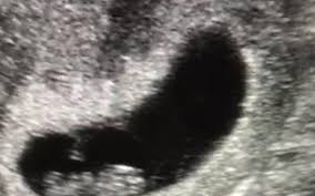 Not what you're looking for? Basic Ultrasound Scan In Pregnancy The Red Clinic