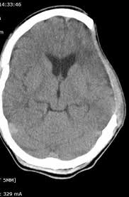 sinking skin flap syndrome, post