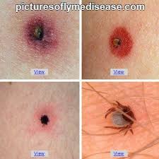 Pin On Ticks On Humans