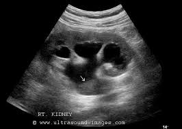 A Gallery Of High Resolution Ultrasound Color Doppler 3d Images Ureteric Calculi