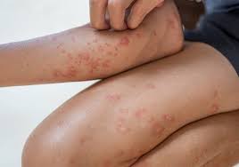 A patologia do couro cabeludo tem variação de teor leve a gravíssima. Psoriases Na Pediatria Articulos Intramed