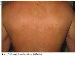 Pityriasis alba refers to a skin condition involving mostly children and young adults. Klinisch Diagnostisches Vorgehen Bei Pigmentstorungen Dermatologie Universimed Medizin Im Fokus