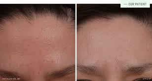 Image result for Sebaceous Hyperplasia