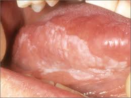 Image result for white cancer on tongue)