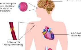 Většinou je možné prokázat její příčinu, a tedy hovoříme o sekundární plicní hypertenzi. I270 Primarni Plicni Hypertenze Priznaky A Lecba